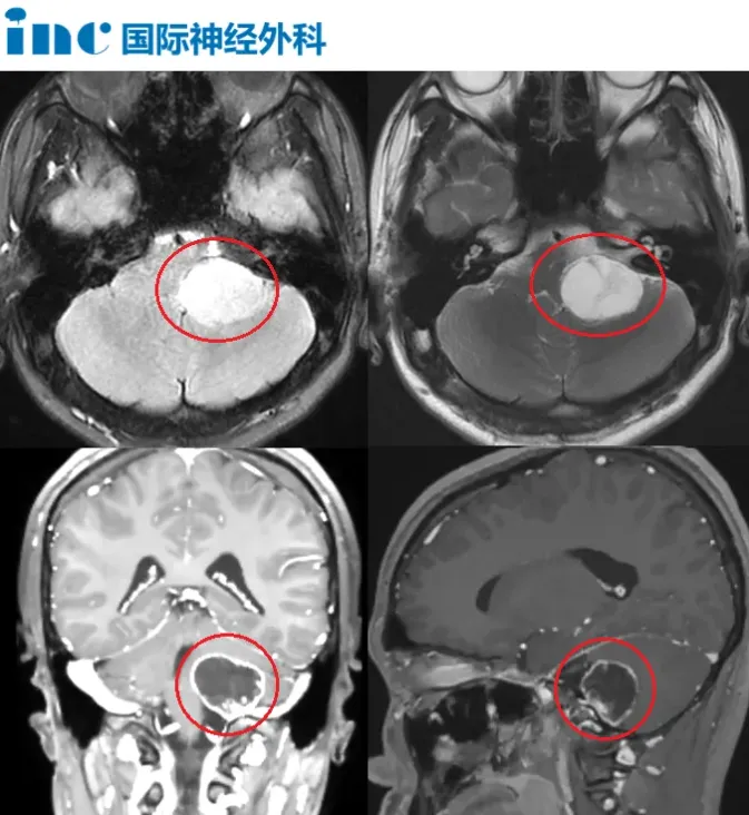 在颅脑深处一个叫“颈静脉孔区”的狭小空间里，长了一颗不小的肿瘤。