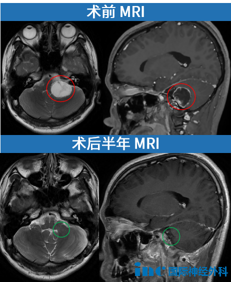 术前术后MRI对比