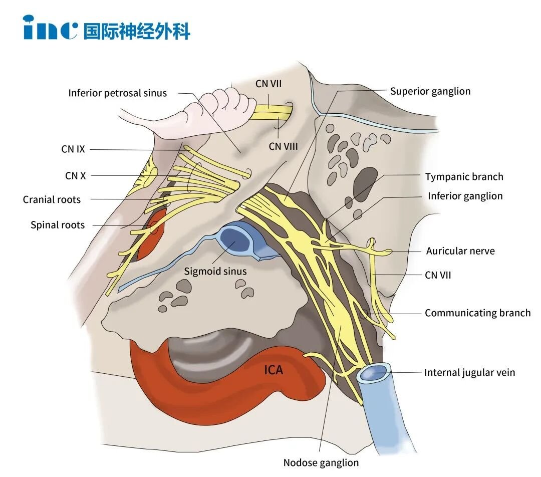 颈静脉孔位于颅底深部，范围狭小，内部走行着舌咽神经、迷走神经、副神经以及乙状窦、颈内动脉等关键结构。