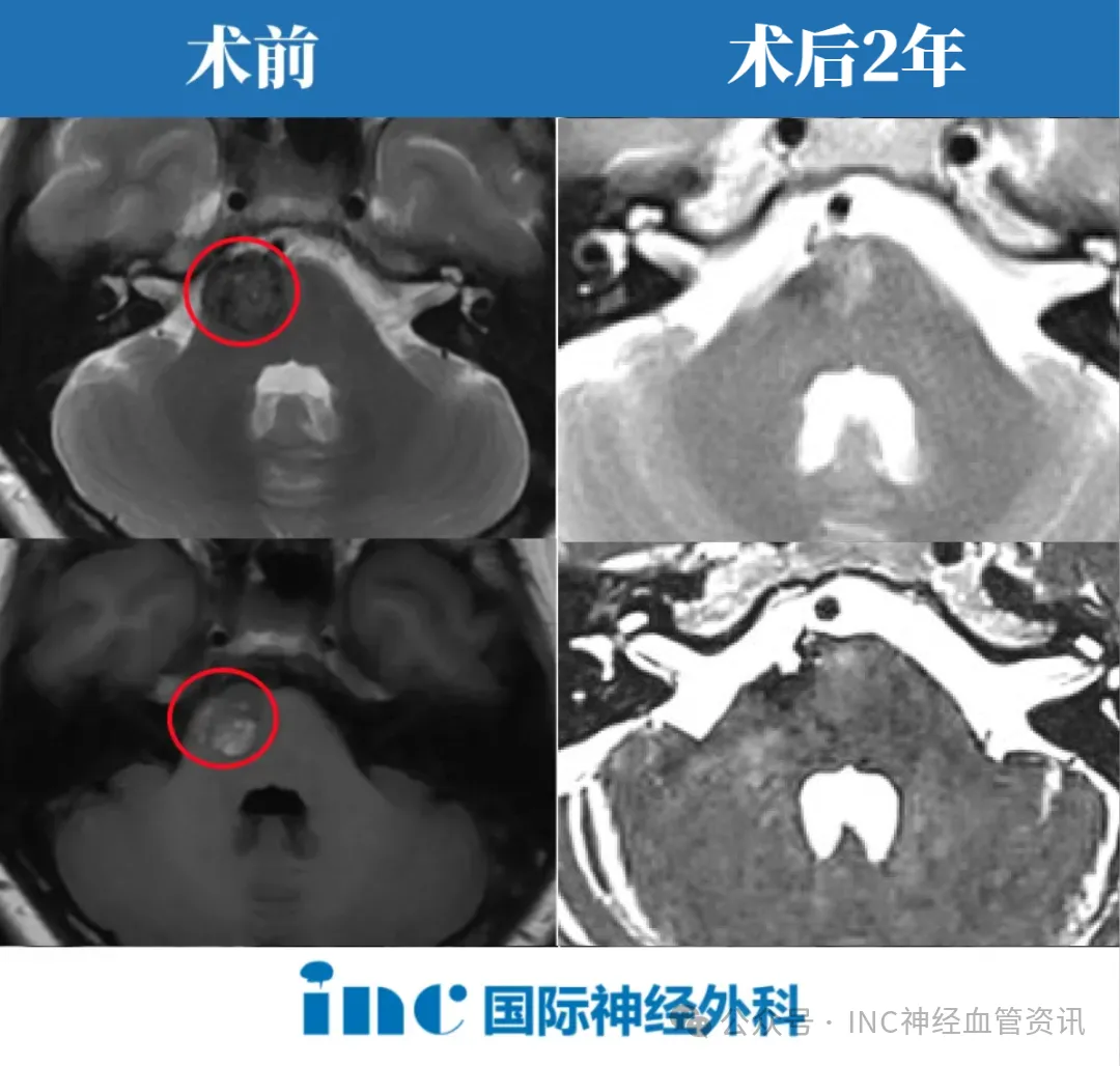 COMPLETE cavernoma removal（病灶全切）