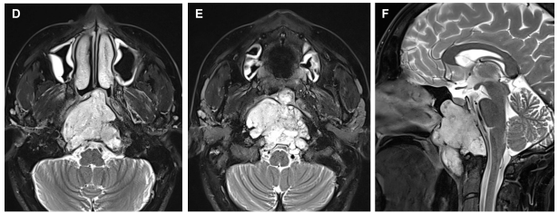 不开颅、从鼻子进去、切干净了，这台颅底肿瘤手术，如何打破三大＂难题＂？