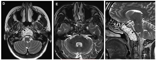 手术结束，术后MRI证实：无残留，全切除。
