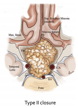 单侧鼻甲黏膜切开及采用II型技术的缝合示意图