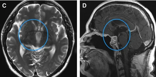 施罗德教授的选择是：在充分保护视神经、下丘脑和血管的前提下，追求最大程度的全切。