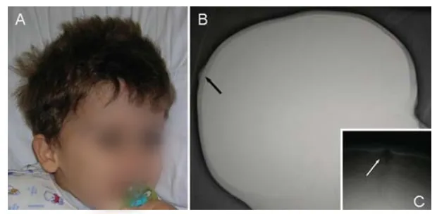 图1.患儿面部照片。可见静脉淤血及巨头畸形。侧位及正位颅骨X线片显示头皮肿块（B，黑色箭头）及1.5厘米的骨缺损（C，白色箭头）。