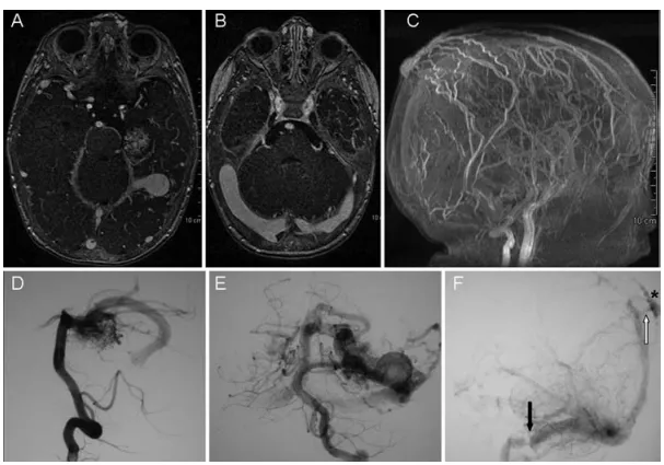脑部血管磁共振成像检查。可清晰显示颞叶内侧病灶及静脉动脉瘤，右侧横窦扩张，以及扩张的皮下静脉。椎动脉造影侧位及正位像显示由左侧大脑后动脉颞支供血、经一条显著扩张的静脉引流的动静脉畸形。可见邻近横窦的巨大静脉动脉瘤，乙状窦闭锁，以及由此导致的血流经一条导静脉反流入上矢状窦和颅外皮下循环。