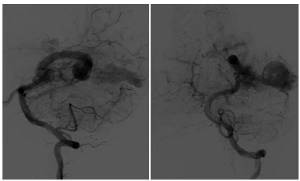 图3.第三次栓塞术后血管造影显示，动静脉畸形病灶显著缩小，仅残余少量由左侧大脑后动脉供血的残余部分。静脉动脉瘤仍然存在。