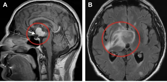术前鞍上增强MRI显示，肿瘤延伸至第三脑室，有实性成分(a)。视神经交叉向前移位(箭头)。垂体和蝶鞍似乎正常。由于T2病灶周围水肿和反转恢复图像液体衰减并右侧基底神经节外侧延伸，怀疑下丘脑侵犯(B)。