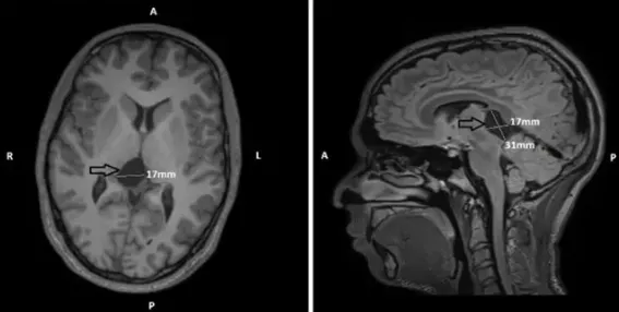 孩子被误认为“睡神”，医生却说他的大脑“被休眠”急需手术！