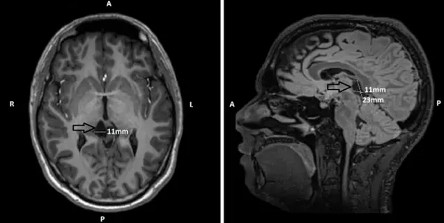囊肿已显著缩小，中脑的压迫完全解除