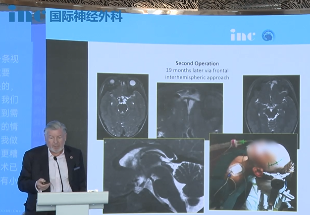 胶质瘤复发还能活多久？那个19个月大的男孩再次手术后，如今当爸爸了！