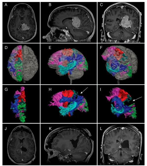 术前影像、纤维束成像与术后影像