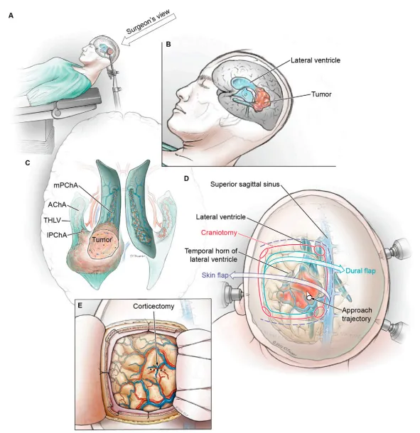 图2-体位摆放与开颅