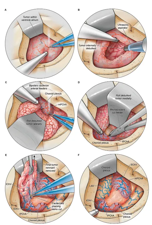 图3-肿瘤移动与供血血管处理