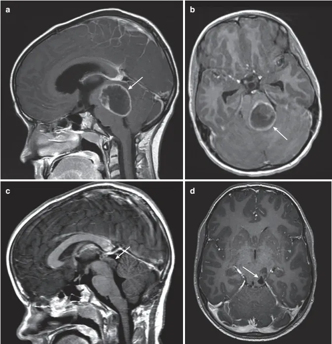 中脑顶盖胶质瘤