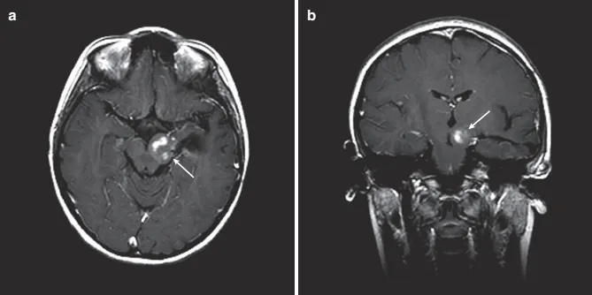一位儿童脑桥胶质瘤的术后。该病例使用左侧颞中回入路，在颞部开颅手术后切除病灶。神经导航用于识别肿瘤的边界及关键神经组织定位，用穿孔锥来减少病灶体积。(a) 轴位 T1增强 MRI 显示肿瘤的轨迹及占据左侧被盖的肿瘤小残留。(b)冠状位增强 MRI，描绘了从颞中回通向中脑的肿瘤轨迹和小残留。该患者后续进行了化疗，不需要再次手术。没有新的神经功能缺损，但术后2周出现短暂性语言障碍。
