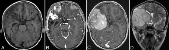 A： 弹簧圈栓塞术后1.5个月，显示右侧额叶残余出血的演变，周围伴有额叶和颞叶脑软化。 B： 栓塞术后11个月，显示右侧外侧裂内有一个2.3 × 2.7 × 1.8 厘米的软组织肿块，包绕右侧大脑中动脉三分叉并累及邻近硬脑膜。 C和D： 术后13个月，显示一个8 × 7.2 × 7 厘米的肿块，包绕右侧大脑中动脉，并延伸至前颅窝和中颅窝。可见明显的占位效应、中线移位及凸面硬脑膜受累。