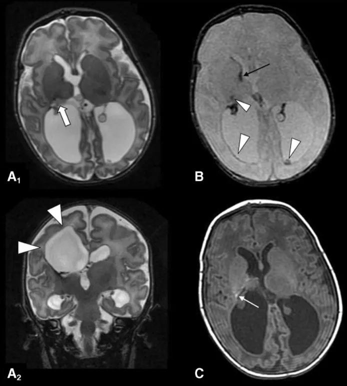 图1.分娩后10天获得的MRI检查，显示结果符合既往的Papile III级生发基质出血和脑室周围白质软化。 轴位（A1）和冠状位（A2）T2加权涡轮自旋回波图像显示侧脑室扩张，以及右侧脑室周围（箭头标示处）、内囊后肢和丘脑（箭头标示处）的软化性改变。T2*加权序列（B）在丘脑-尾状核沟水平（细箭头标示处）、内囊后肢和脑室壁（箭头标示处）显示了出血后含铁血黄素沉积。T1加权图像（C）在内囊后肢水平也可见微小的正铁血红蛋白沉积（细箭头标示处）。