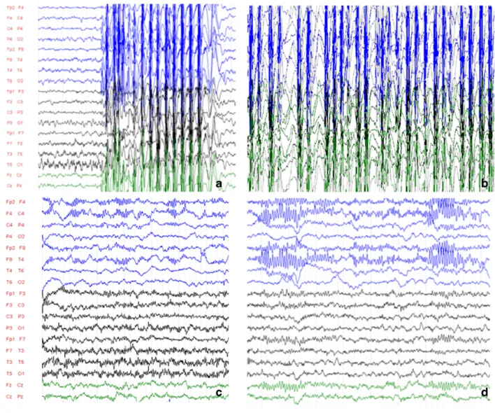 图2.功能性半球切除术前后脑电图。a（清醒），b（睡眠）手术前（5岁6个月大时）；c（清醒），d（睡眠）手术后六个月。