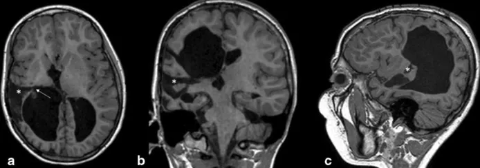 图3.术后MRI随访显示手术右侧岛周功能断联发生变化。a–c中的星号表示岛周夹层，并切除上颞回和中颞回。箭头（a）显示内囊切断至心室心房。