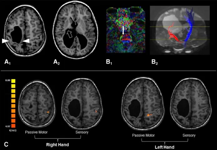 图5.患者感觉运动结构损伤与功能重组的多模态MRI评估。 轴位T1-MPRAGE图像显示右侧脑室周围白质软化性改变，广泛累及中央前回和中央后回，以及丘脑后部和内囊后肢。在微观结构DTI分析中，与对侧未受影响侧相比，右侧皮质脊髓束纤维显示不清。皮质脊髓束的纤维束追踪重建显示，由于右侧皮质脊髓束的数量和长度相对于左侧减少，存在明显的不对称性。功能评估结果叠加在解剖MPRAGE图像上。左侧中央沟由虚线标出。右手被动运动和感觉任务分别在左侧中央前回和中央后回引发了显著激活。左手被动运动任务在同侧左侧中央前回水平引发了激活，而感觉任务未发现显著激活。重要的是，任何任务均未在右侧大脑半球检测到显著激活。图像按放射学惯例呈现。
