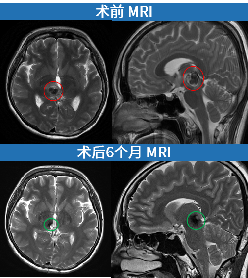 术前术后MRI对比