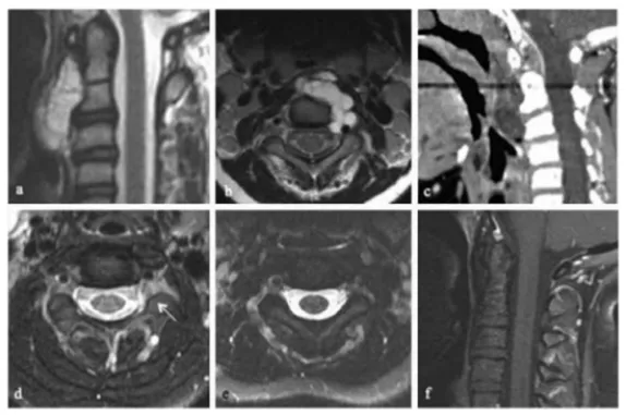 C1–C3 脊索瘤影像示例 (a) 术前 矢状位T1 加权增强 MRI（gadolinium）； (b) 术前 轴位T1 加权增强 MRI； (c) 术前 矢状位CT； (d) 术后 轴位T1 加权增强 MRI，可见C2–C3 神经孔内小残余肿瘤（箭头）； (e) 放疗后 轴位T1 加权增强 MRI； (f) 放疗后 矢状位T1 加权增强 MRI。