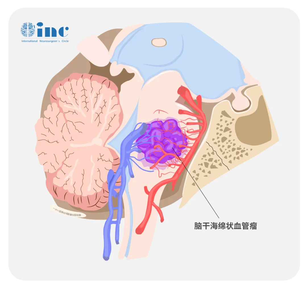 孩子脑干出血，是等待观察还是尽快手术？把握治疗时机很重要