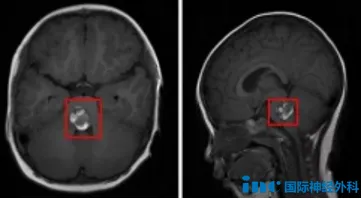 脑干出血是神经系统急重症，不及时手术将有生命危险。