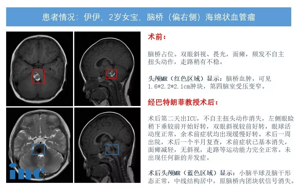 术后一个半月复查时，原有的斜视、走路不稳等症状全部消失，面瘫明显减轻，行动能力完全正常，没有出现任何新的并发症。