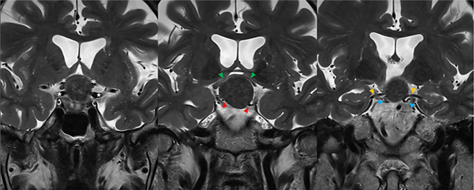 全切与保功能只能二选一？粘连严重、血供丰富的鞍区肿瘤，国际大咖如何精准切除？