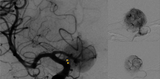 肿瘤血供丰富，术中出血风险极高