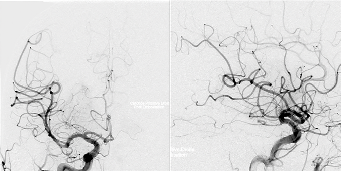 术前进行血管栓塞，切断肿瘤的主要血供。