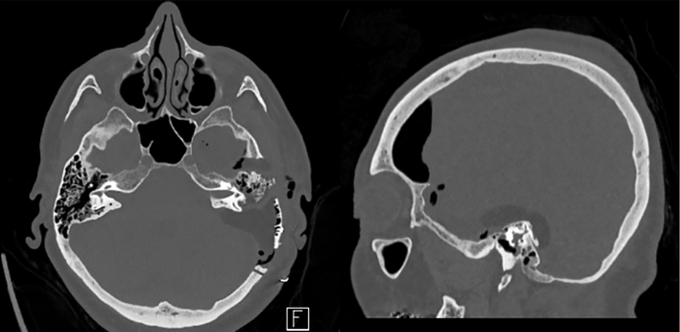 手术后无新发神经功能障碍，无内分泌功能损伤，一周后顺利出院