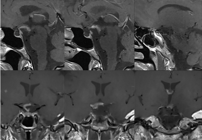 组织病理学结果最终证实了垂体细胞瘤的诊断。