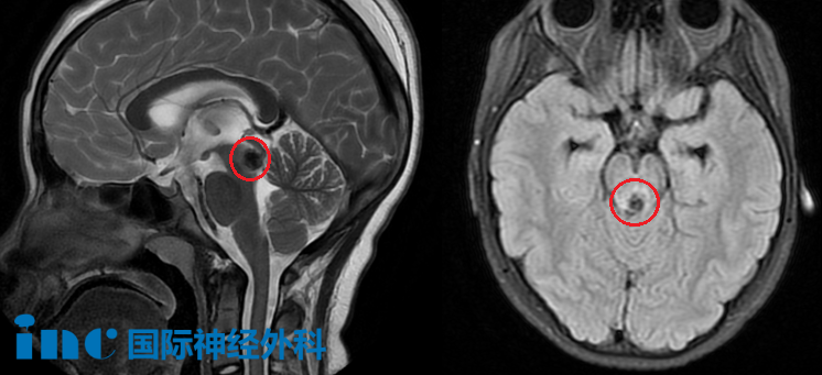 女儿感冒查出脑干占位