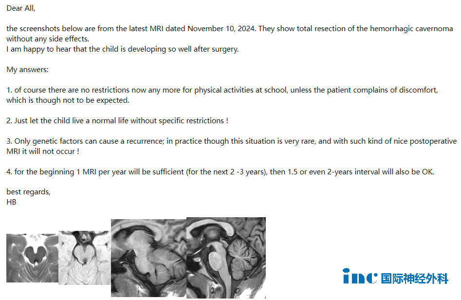 Dear All,  the screenshots below are from the latest MRI dated November 10, 2024. They show total resection of the hemorrhagic cavernoma without any side effects.  I am happy to hear that the child is developing so well after surgery.  My answers:  of course there are no restrictions now any more for physical activities at school, unless the patient complains of discomfort,which is though not to be expected.  Just let the child live a normal life without specific restrictions!  Only genetic factors can cause a recurrence; in practice though this situation is very rare, and with such kind of nice postoperative MRI it will not occur!  for the beginning 1 MRI per year will be sufficient(for the next 2-3 years), then 1.5 or even 2-years interval will also be OK.  best regards,  HB