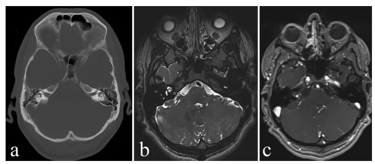 图1. 术前影像，(a) CT图像：显示右侧内听道扩大。(b) MRI图像：显示内听道内的不典型病变。c：增强MRI图像，显示病灶呈中心性钆增强。