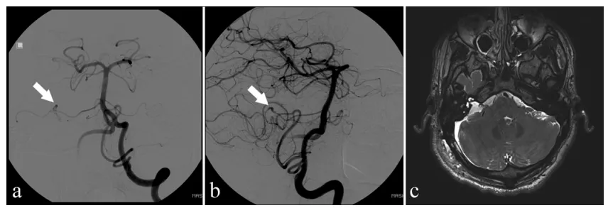 图2. 术后影像，a 和 b：数字减影血管造影图像：显示吻合口通畅，再吻合血管充盈良好，无显著狭窄。c：MRI图像：显示吻合血管充盈良好，未见缺血性卒中。