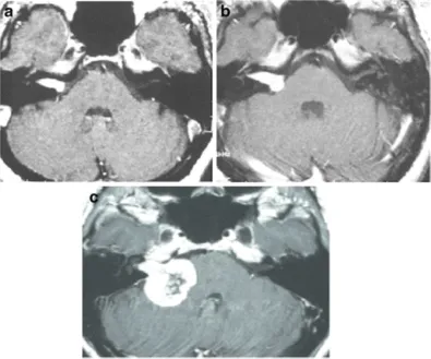 图1 :A.轴位增强 MRI显示右侧内听道内肿瘤，均匀强化(伽玛刀治疗前);B.轴位增强 MRI 显示肿瘤向脑桥小脑角生长(伽玛刀治疗2年后);C.轴位增强 MRI 显示肿瘤进一步生长压迫脑干和小脑(伽玛刀治疗3年后)，肿瘤中心未强化