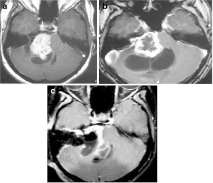 图2 :a增强后轴向核磁共振显示右侧中等大小的肿瘤，不均匀强化压迫脑干。肿瘤具有实体和囊肿部分(在直线加速器治疗之前)。b增强后轴向MRI显示肿瘤实体部分轻微生长，囊性部分增大(直线加速器治疗后8个月)。肿瘤缺乏中央强化。c术后增强轴向MRI显示肿瘤的一小部分残留