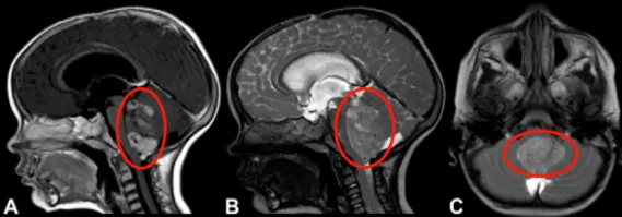 四脑室一个巨大的占位，挤压脑干，安安似乎危在旦夕。