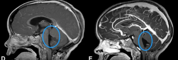术后三年复查均无复发，生活如常。