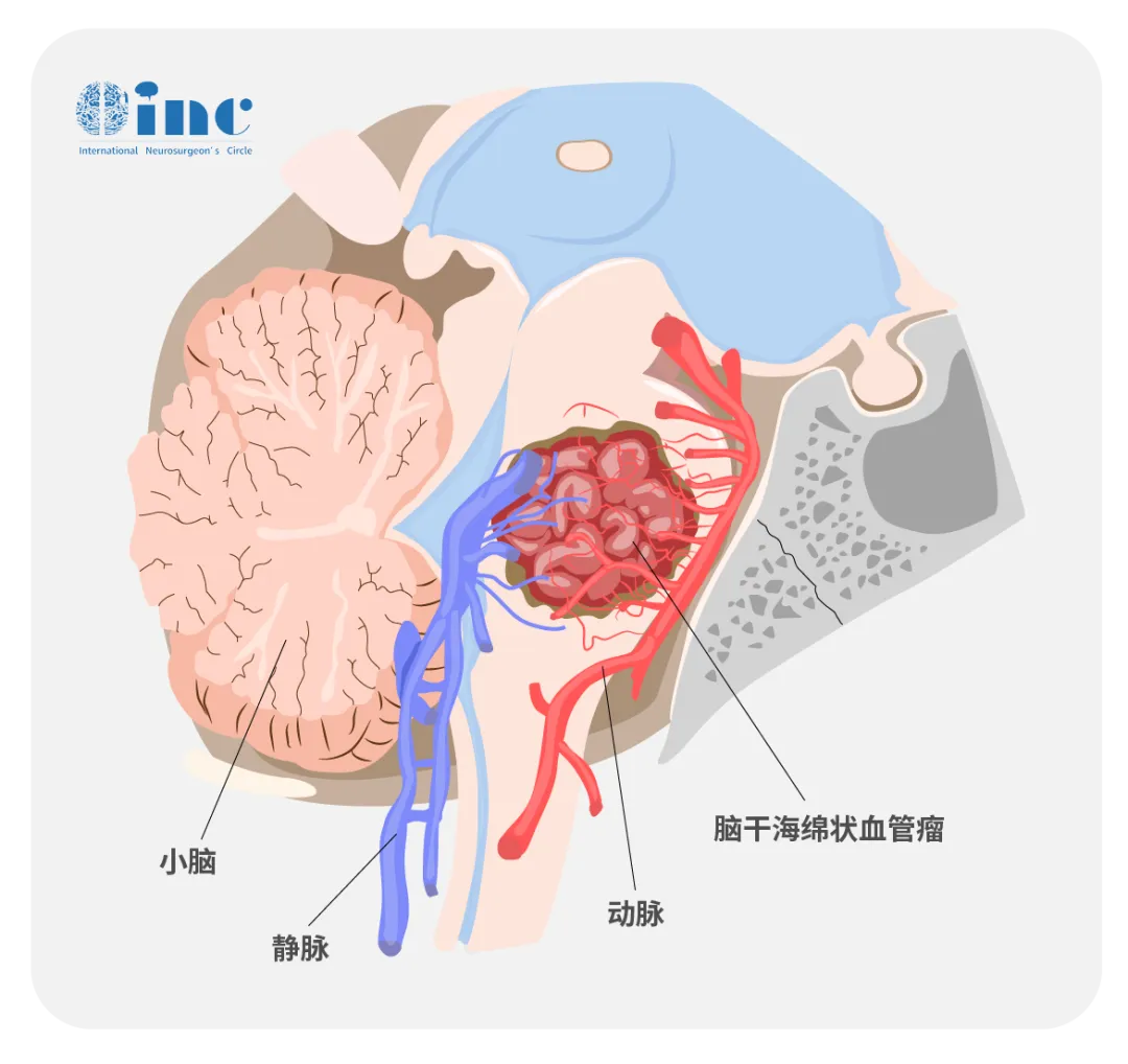 以为伽马刀能搞定，没想到两年后更糟了
