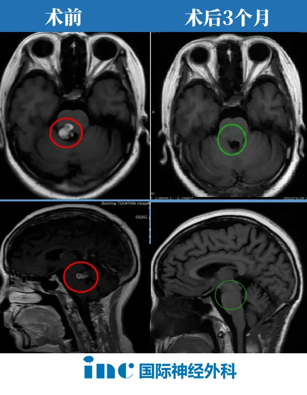 术前术后MRI对比