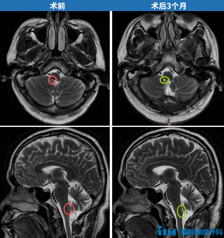 延髓——生命禁区的手术秘密：世界神外专著解读如何破解“不可手术”难题