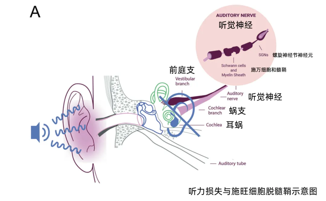 听力损失与施旺细胞脱髓鞘示意图