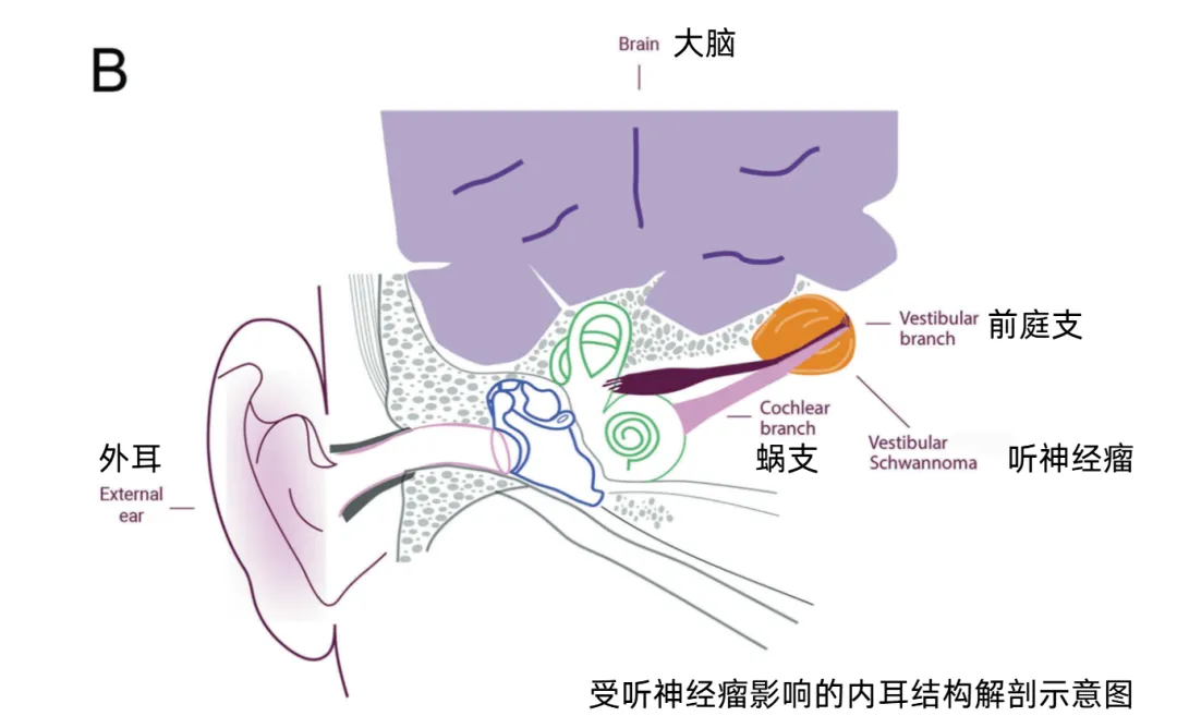 受听神经瘤影响的内耳结构解剖示意图