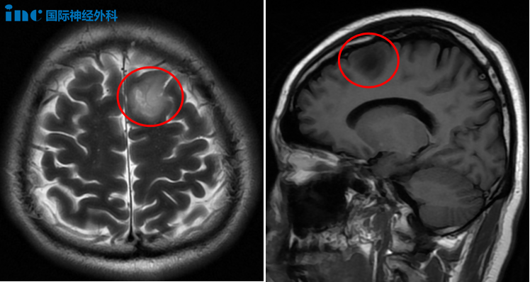 各项指标都好，唯独脑部CT有阴影