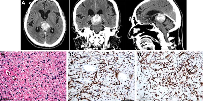 何以“深藏不露”，却“千变万化”？深度解读松果体区肿瘤的临床表现有哪些